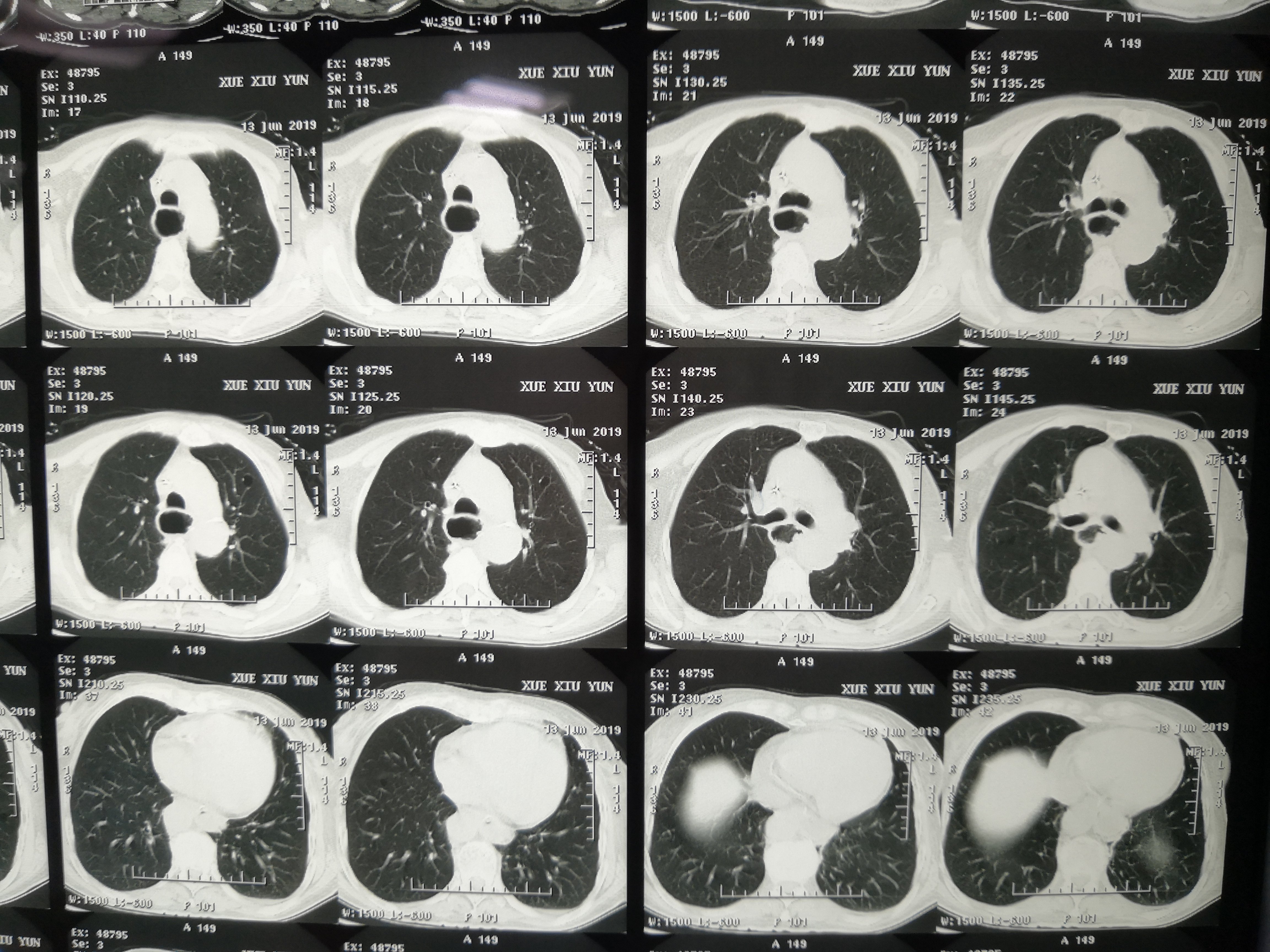 哈医大二院胸外科经典病例之胸腔管状胃 - 好大夫在线