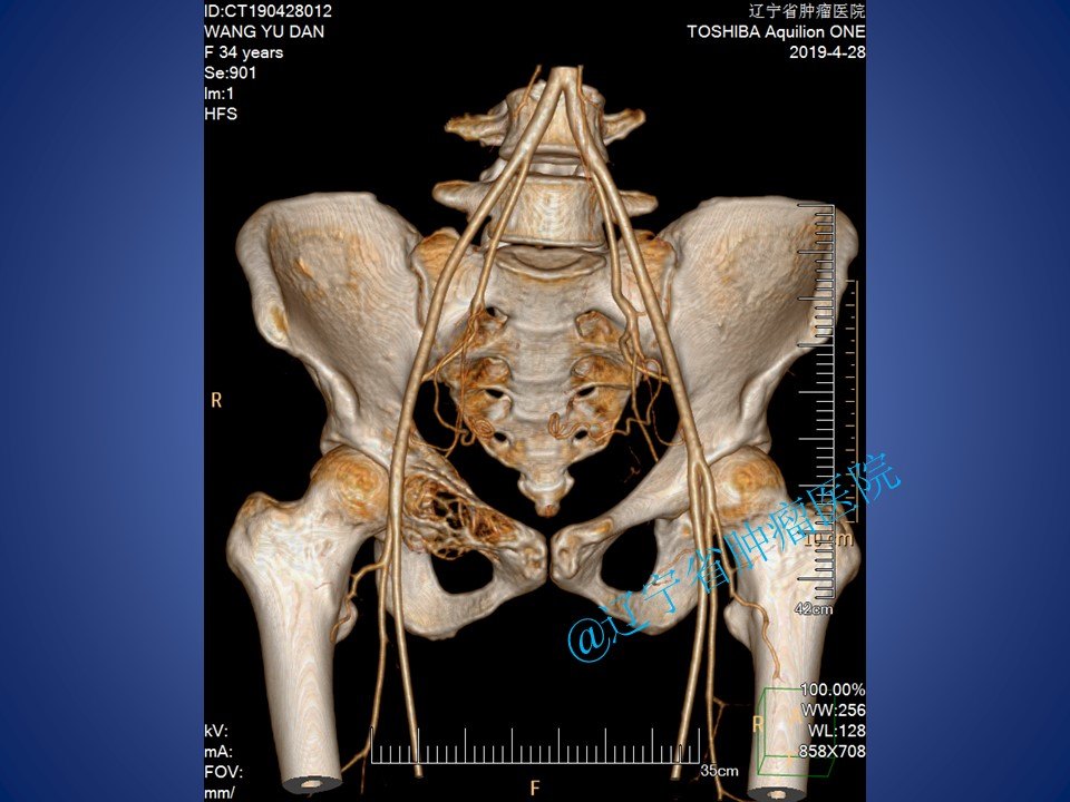 骨盆恥骨腫瘤切除手術病例