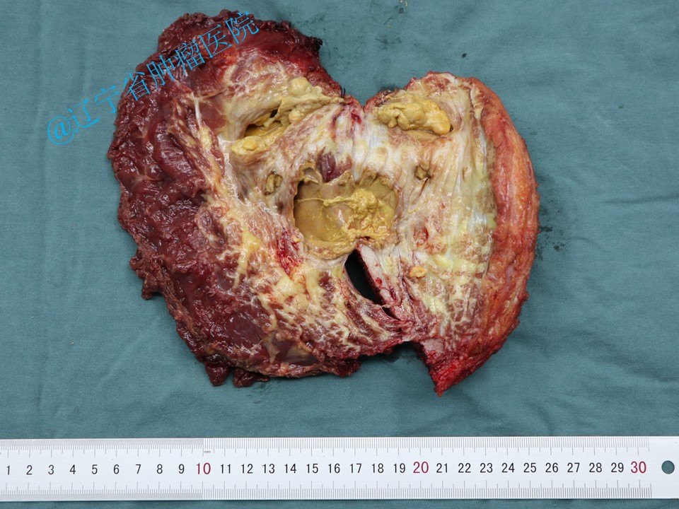 骨盆髂骨肿瘤髂骨次全切除术病例 - 好大夫在线