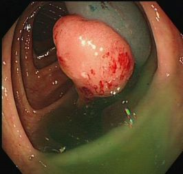 大腸息肉切除3月後複查腸鏡發現闌尾癌1例