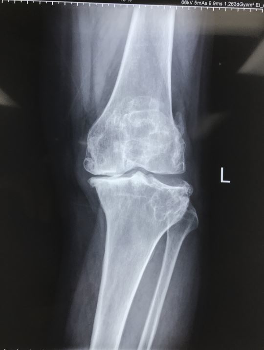 膝关节x光片正常图片
