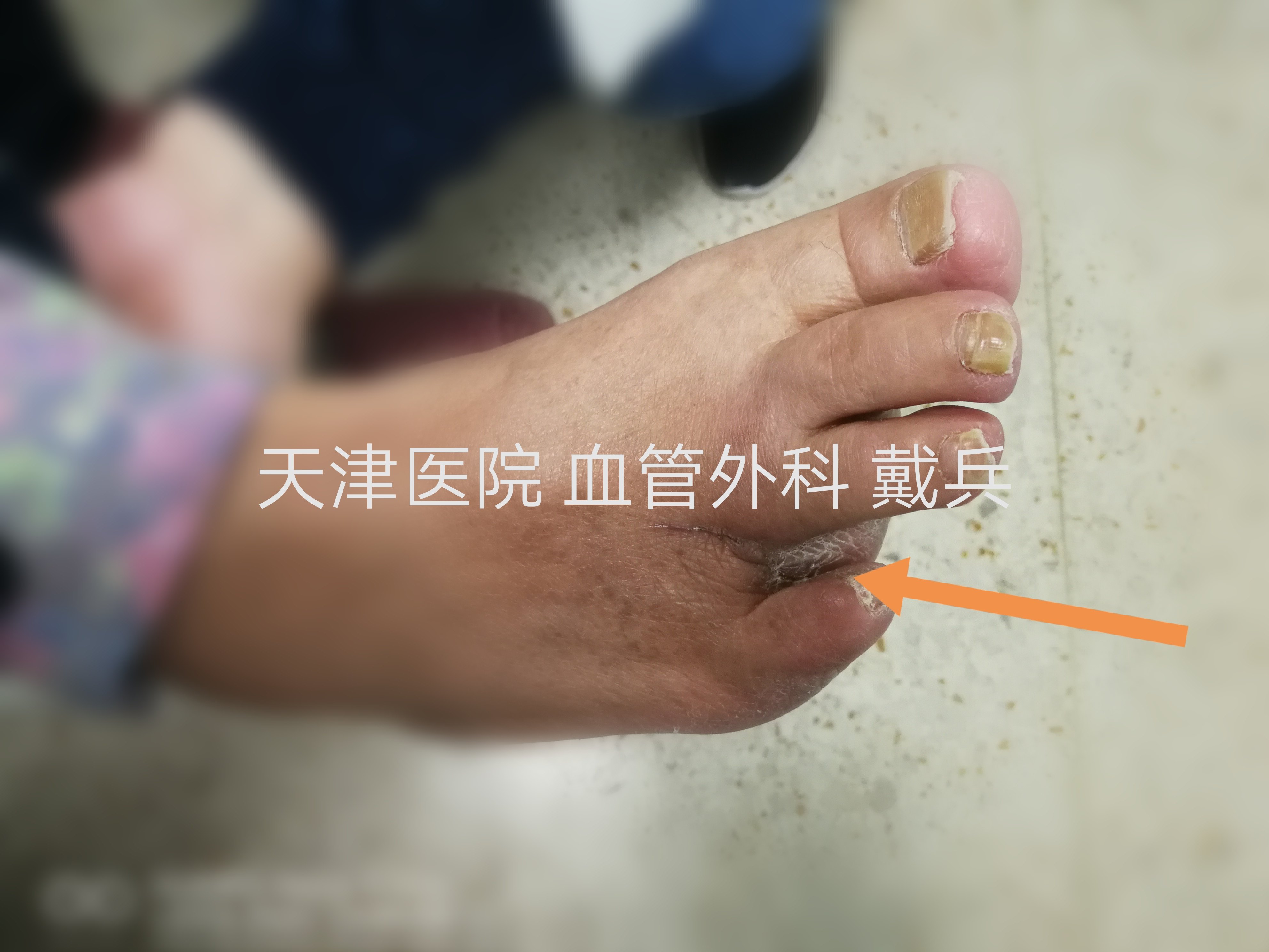 糖尿病足 溃疡 坏死 治疗经验分享 怎么让糖足患者远离截肢风险 早期自查 就诊流程 常见问题集锦 糖尿病足 预防 治疗方法 手术 病因 症状 用药 糖尿病足 溃疡 坏死 治疗经验分享 怎么让糖足患者远离截肢风险 早期自查 就诊流程 常见问题集锦 糖尿病足 预防 治疗方法 手术 病因 症状 用药