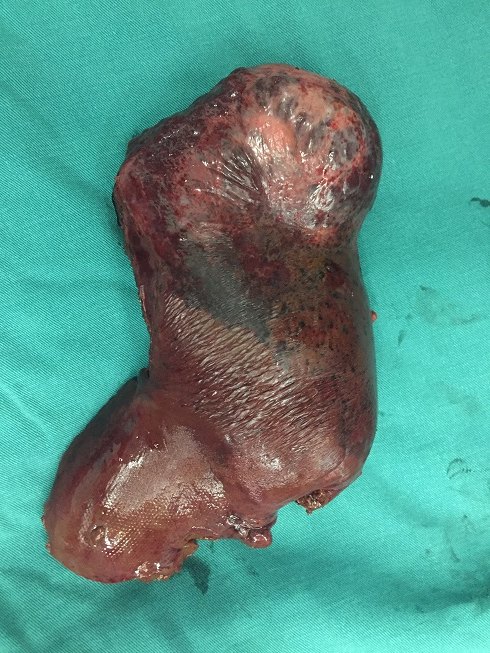 巨大肝血管瘤,占据右半肝,予以切除 