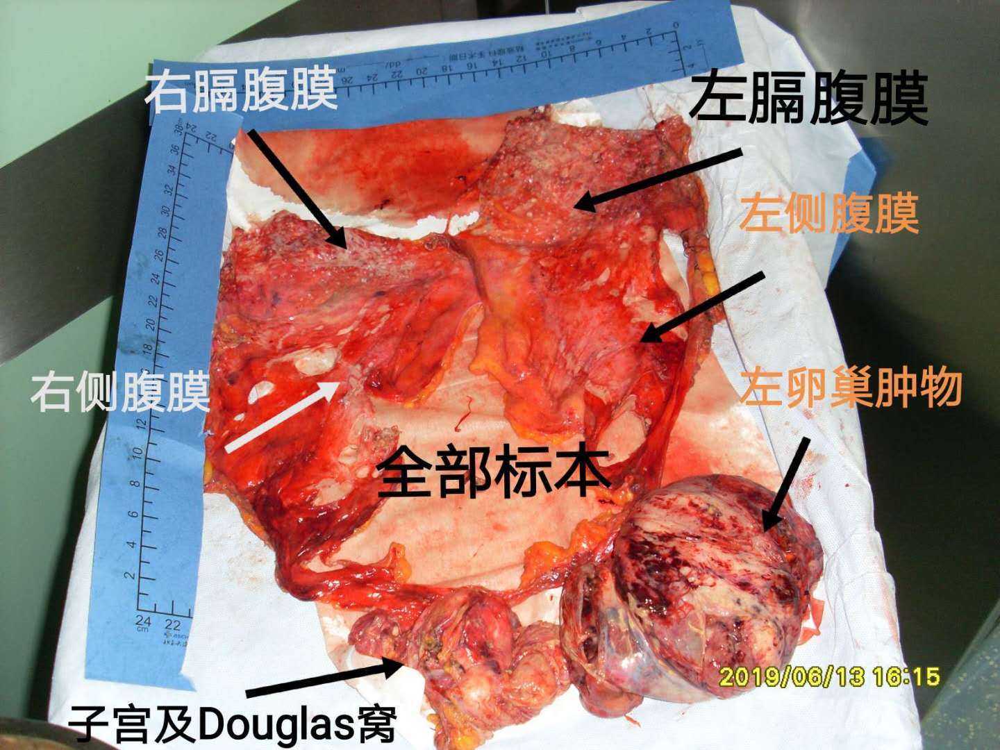 癌细胞扩散到腹腔图片图片