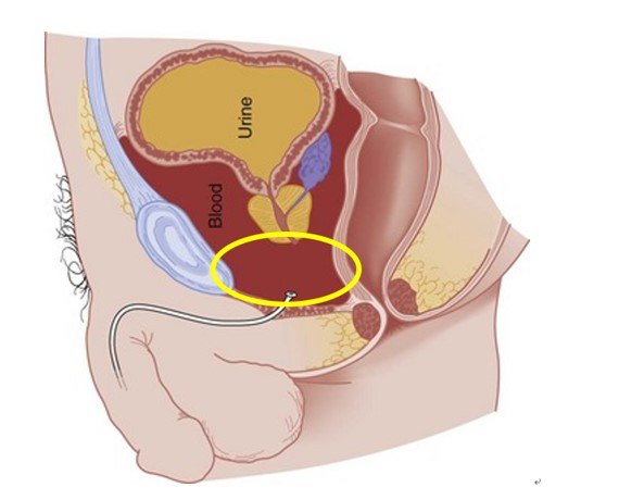 抢修下水道——尿道外伤的急诊处理_尿道损伤_治疗方法_治疗方式 - 好