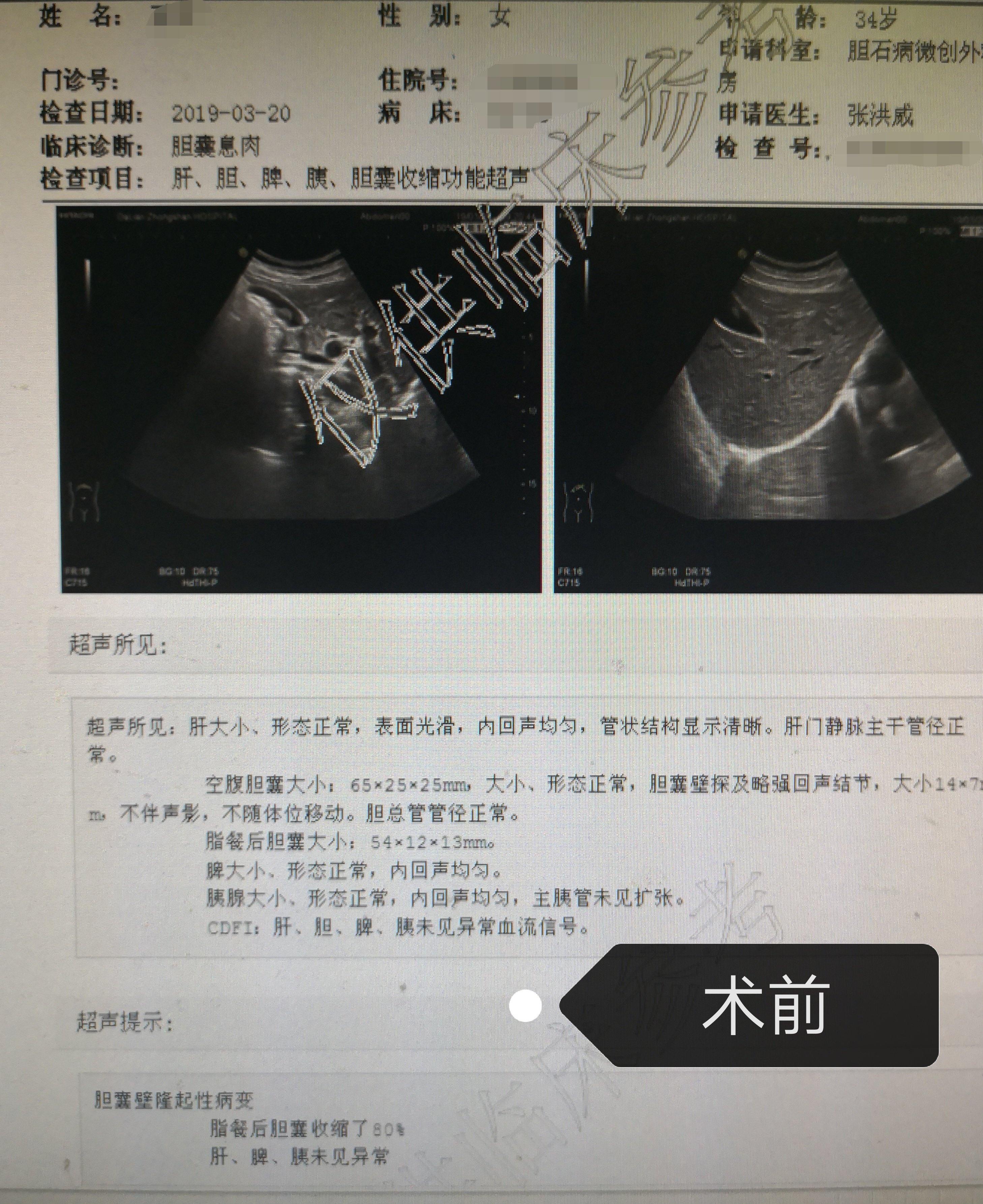 胆囊息肉彩超图片图片