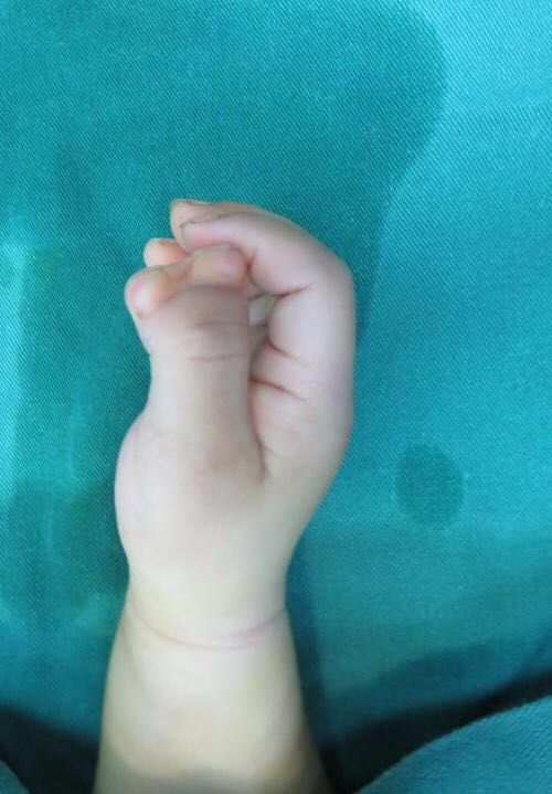 早产儿爪形手图片