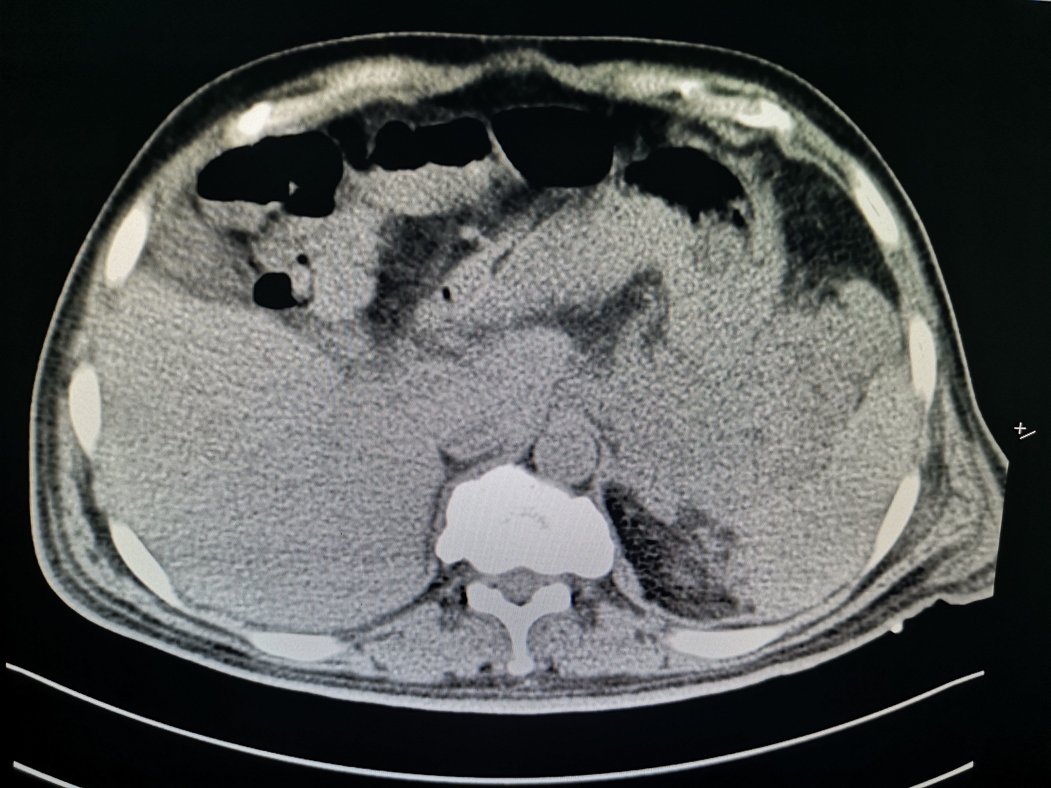 每周诊疗笔记之急性坏死性胰腺炎个体化微创外科治疗 - 好大夫在线