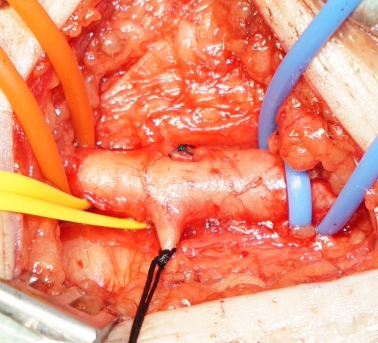 向经典致敬-下肢动脉切开取栓术 - 好大夫在线