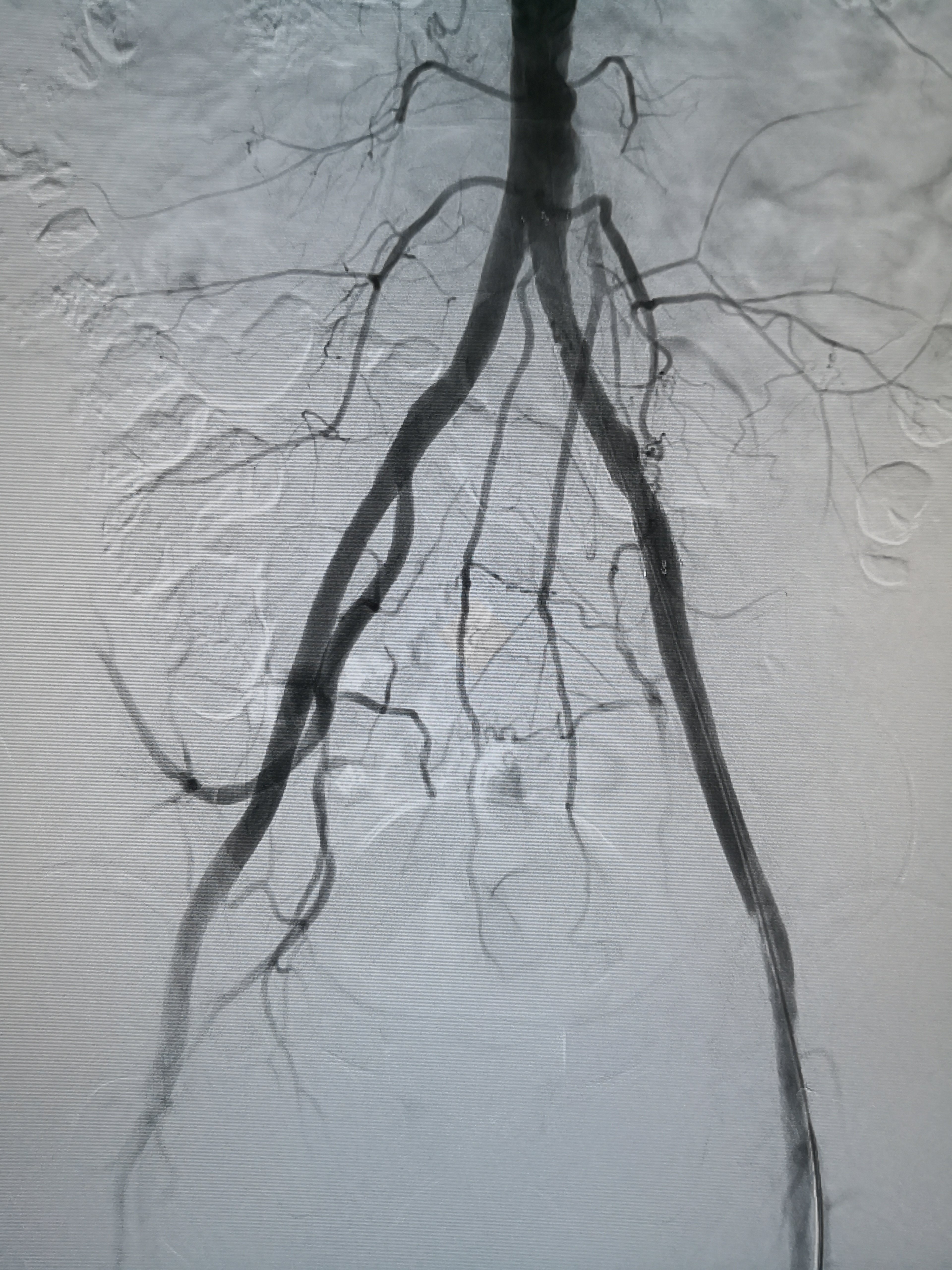向经典致敬-下肢动脉切开取栓术 - 好大夫在线