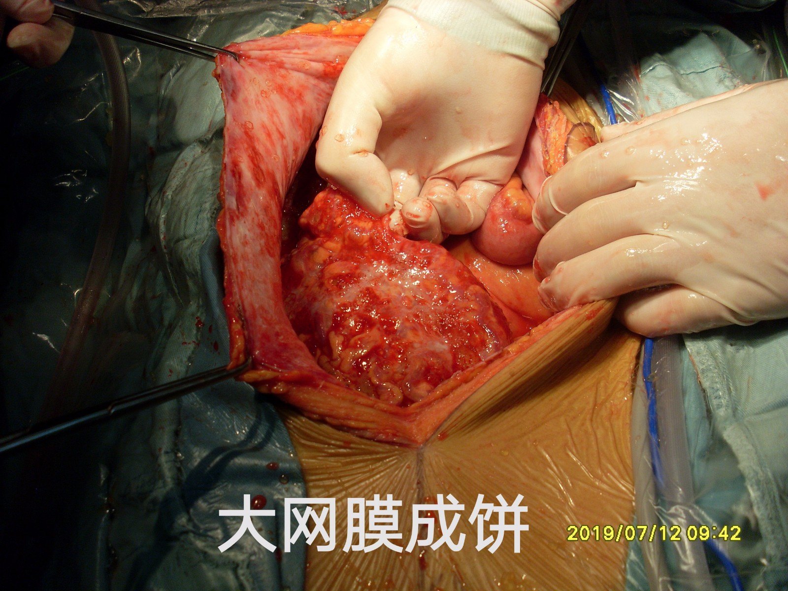 全部结肠成"棍",故决定只行右半结肠 全部大网膜饼切除,清除小肠系膜