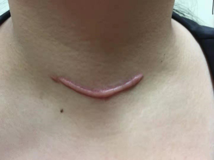 为一位21岁女性甲癌患者完成我院首例经口腔镜甲状腺腺叶切除手术