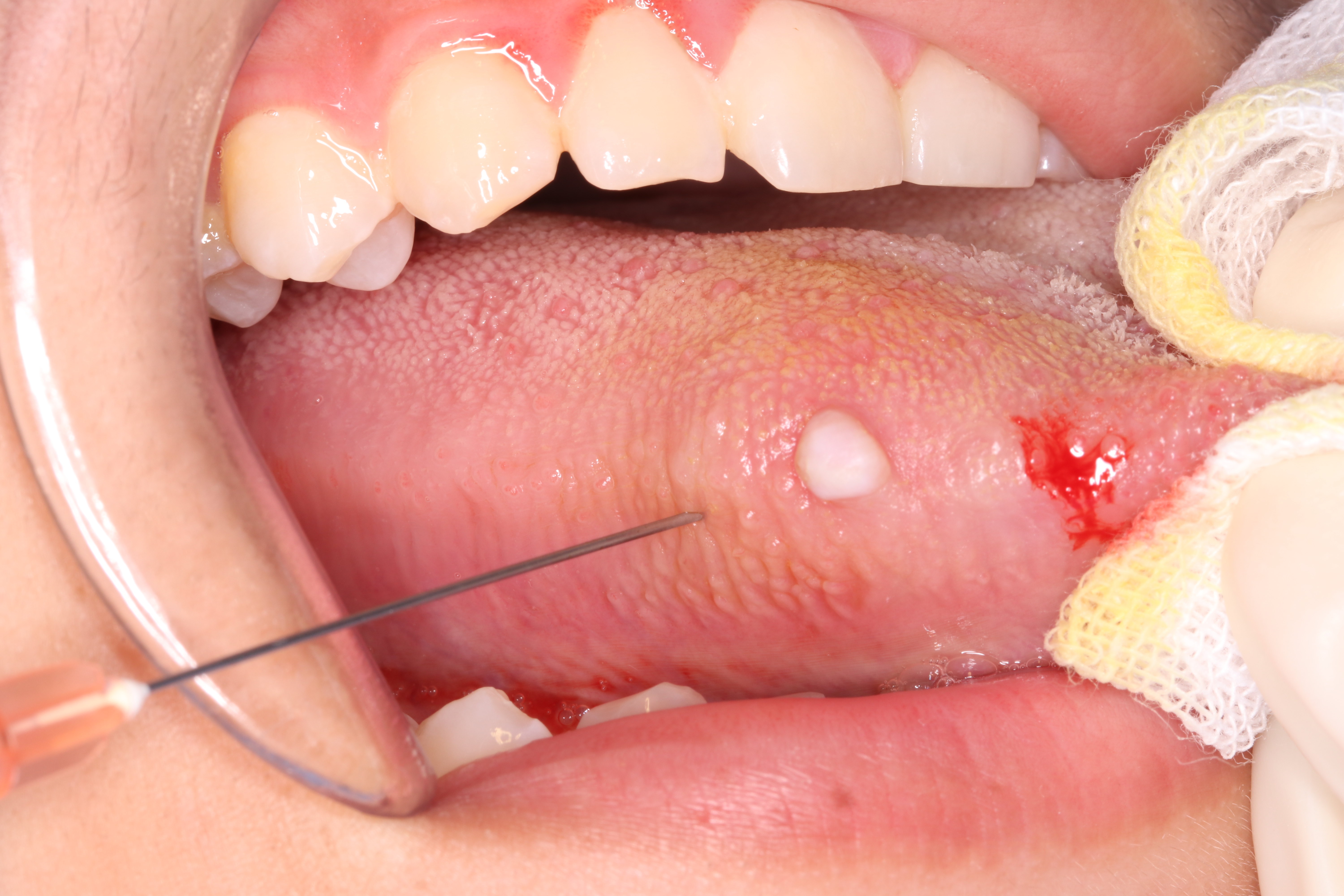 舌头上的小白疱是舌癌