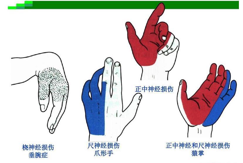常见的周围神经损伤是什么 周围神经损伤 疾病介绍 症状 检查