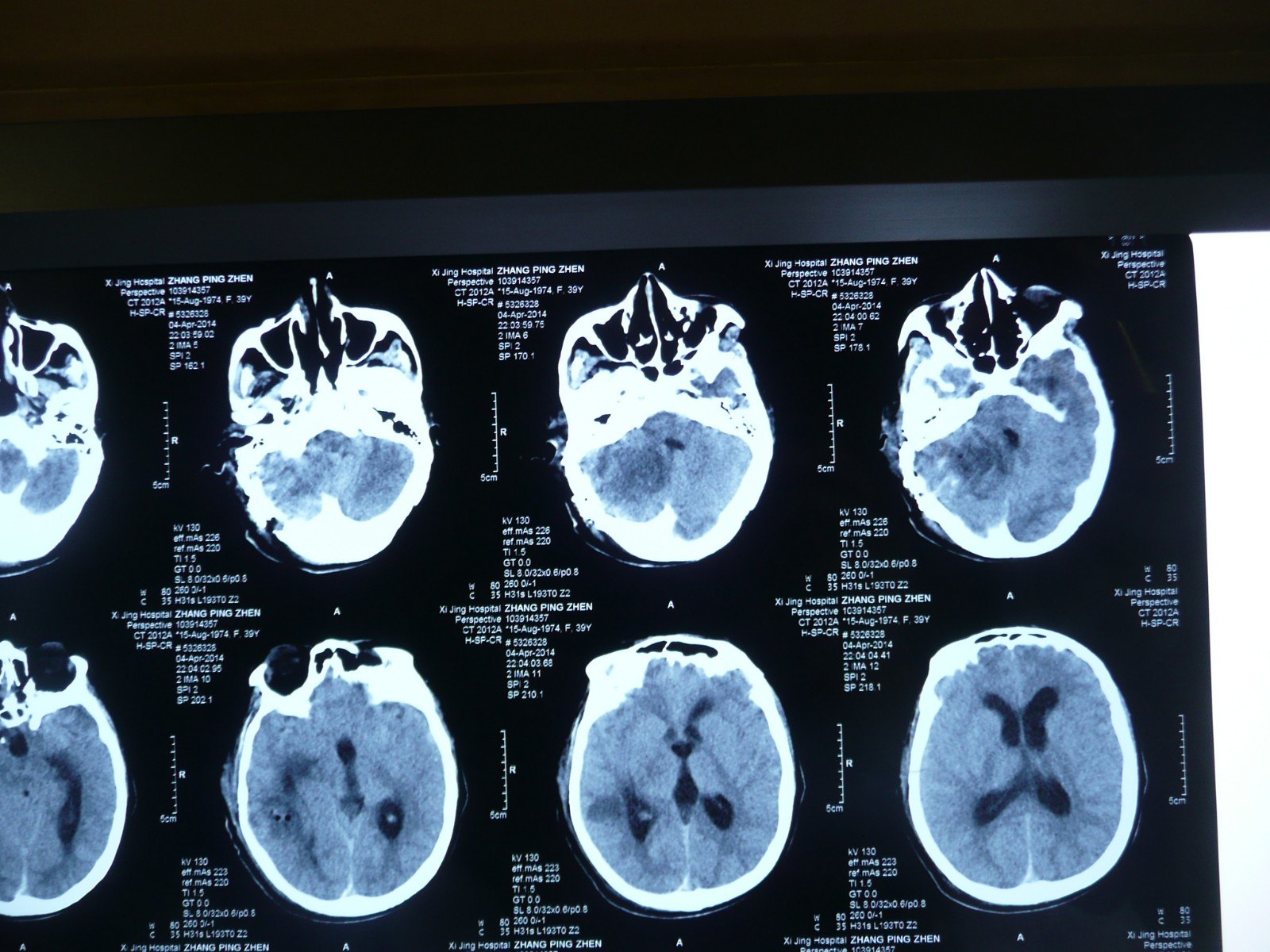 贺晓生教授小脑幕上下骑跨脑膜瘤的外科切除手术案例 - 好大夫在线