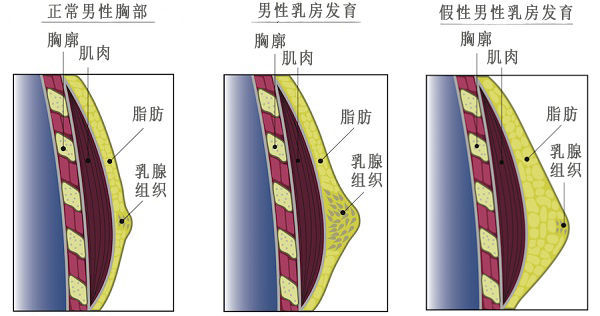 男性乳房发育症乳腺图片