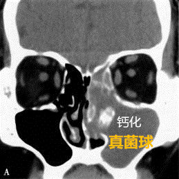 鼻窦炎白色分泌物图片图片