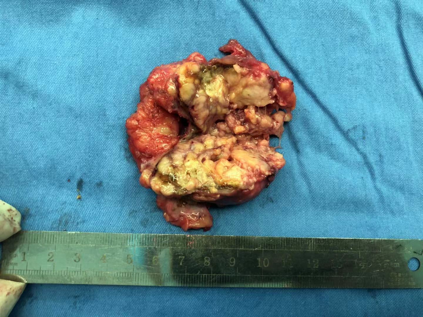 我的手术案例四肾错构瘤自发性破裂后行肾部分切除术一例