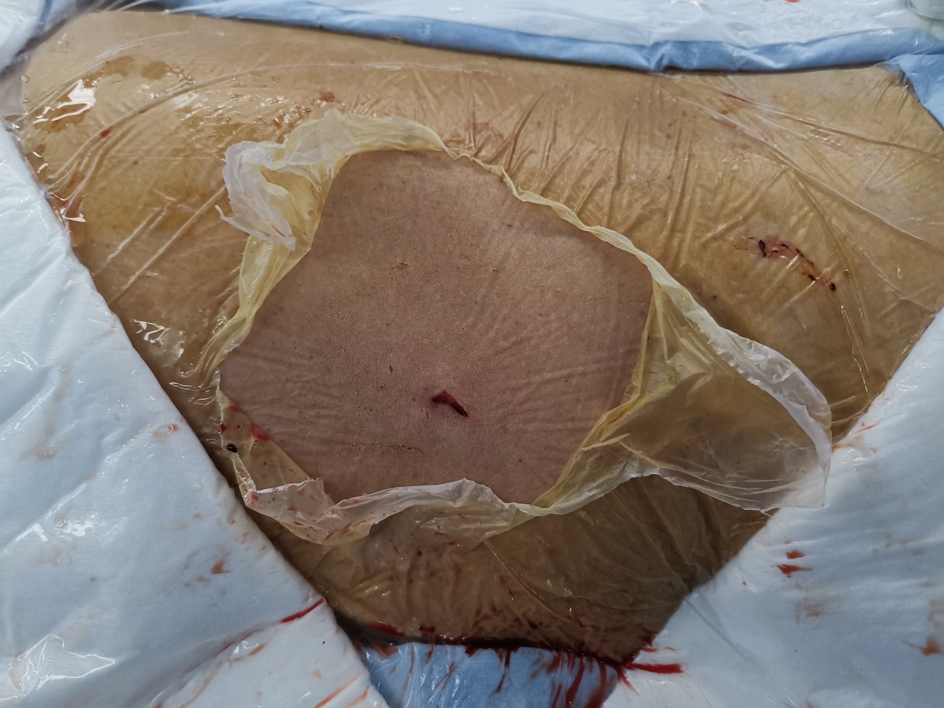 肾造瘘管伤口图片