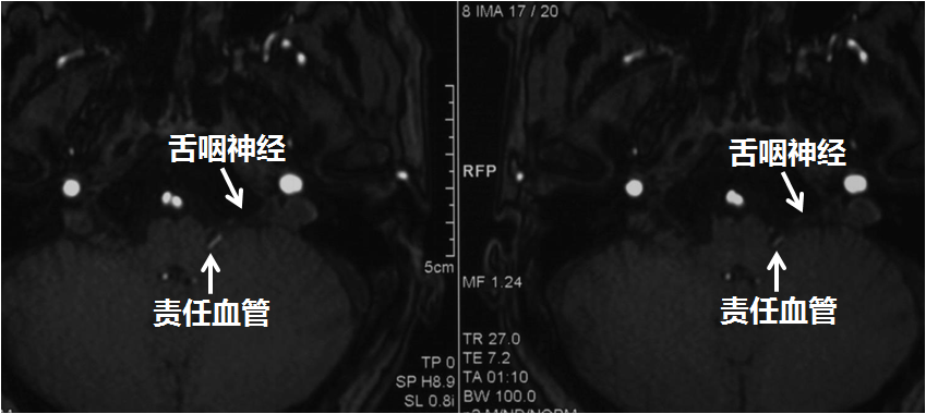 术前头颅mri检查显微血管减压手术—针对病因根治有望9月18日,王景