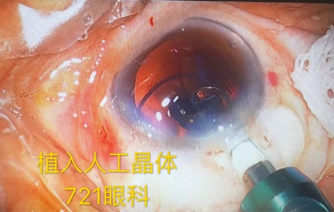 結膜囊內點眼藥膏常用妥布黴素地塞米松眼膏12.敷料包紮