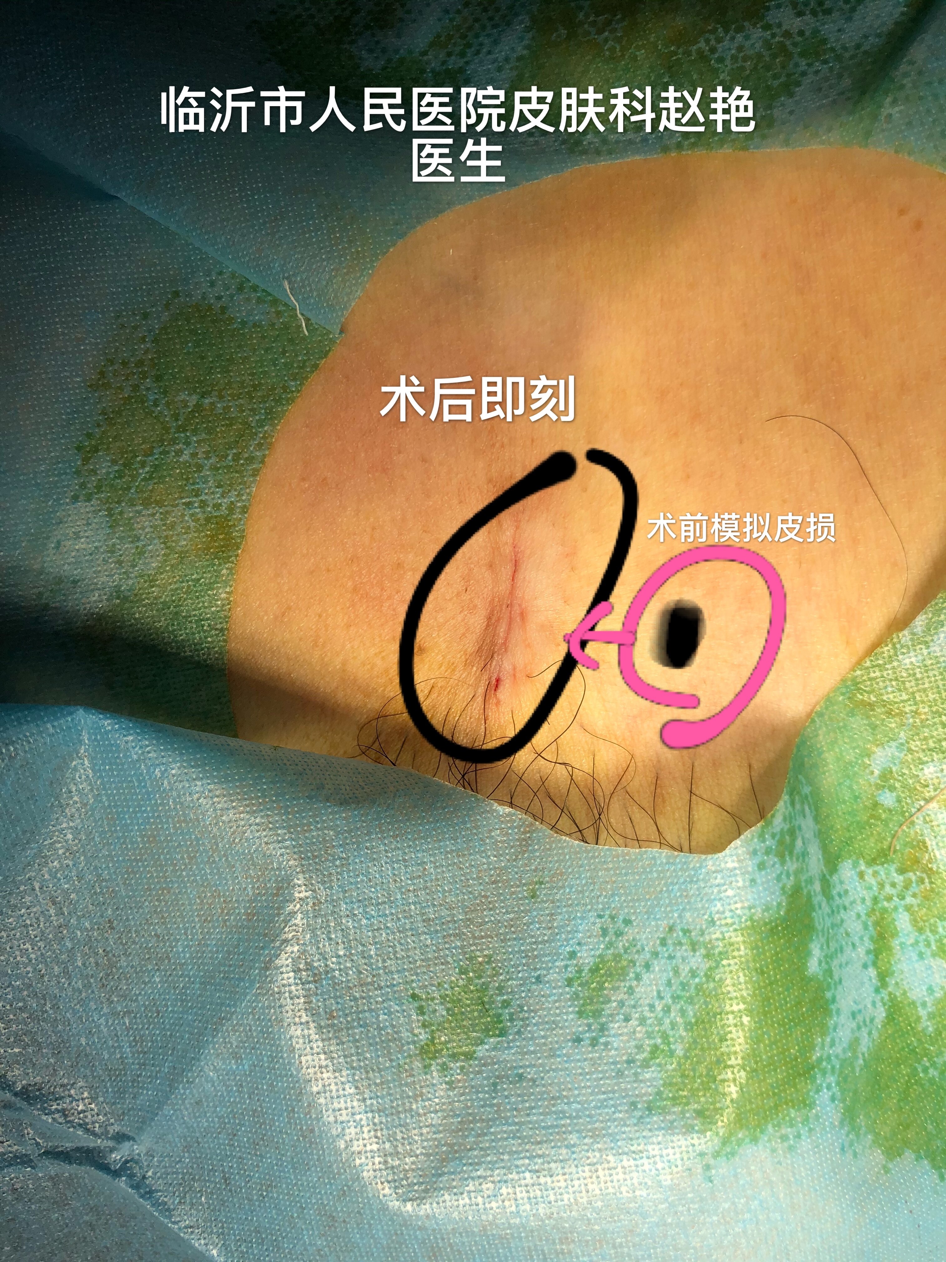 小腹部脂溢性角化病切除,术后手术即刻图片 - 好大夫在线