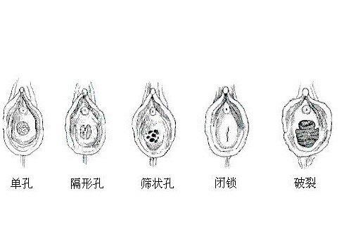 骑自行车会导致处女膜破裂吗