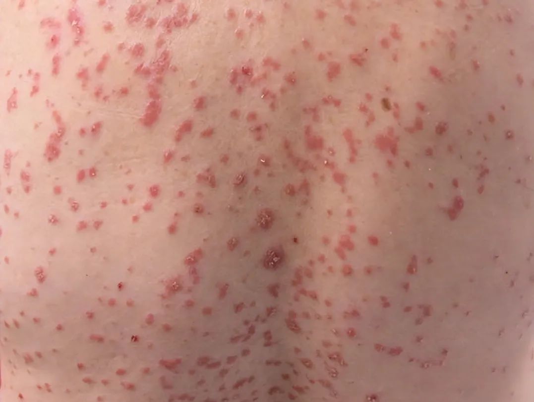 银屑病分型详解:点滴型银屑病的临床表现与诊断