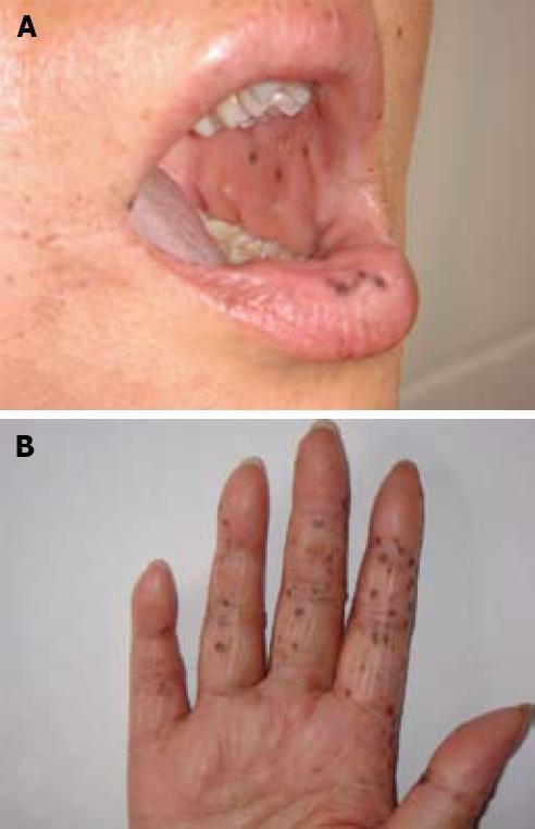口唇见斑,病在大肠,根在遗传,看图识病,你也可以_肠疾病 - 好大夫在线