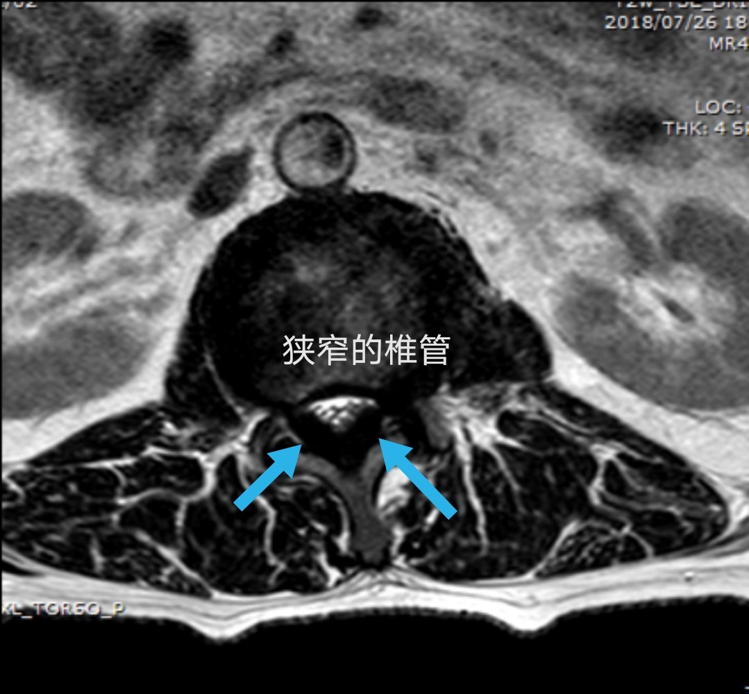 腰椎管狭窄症的微创治疗