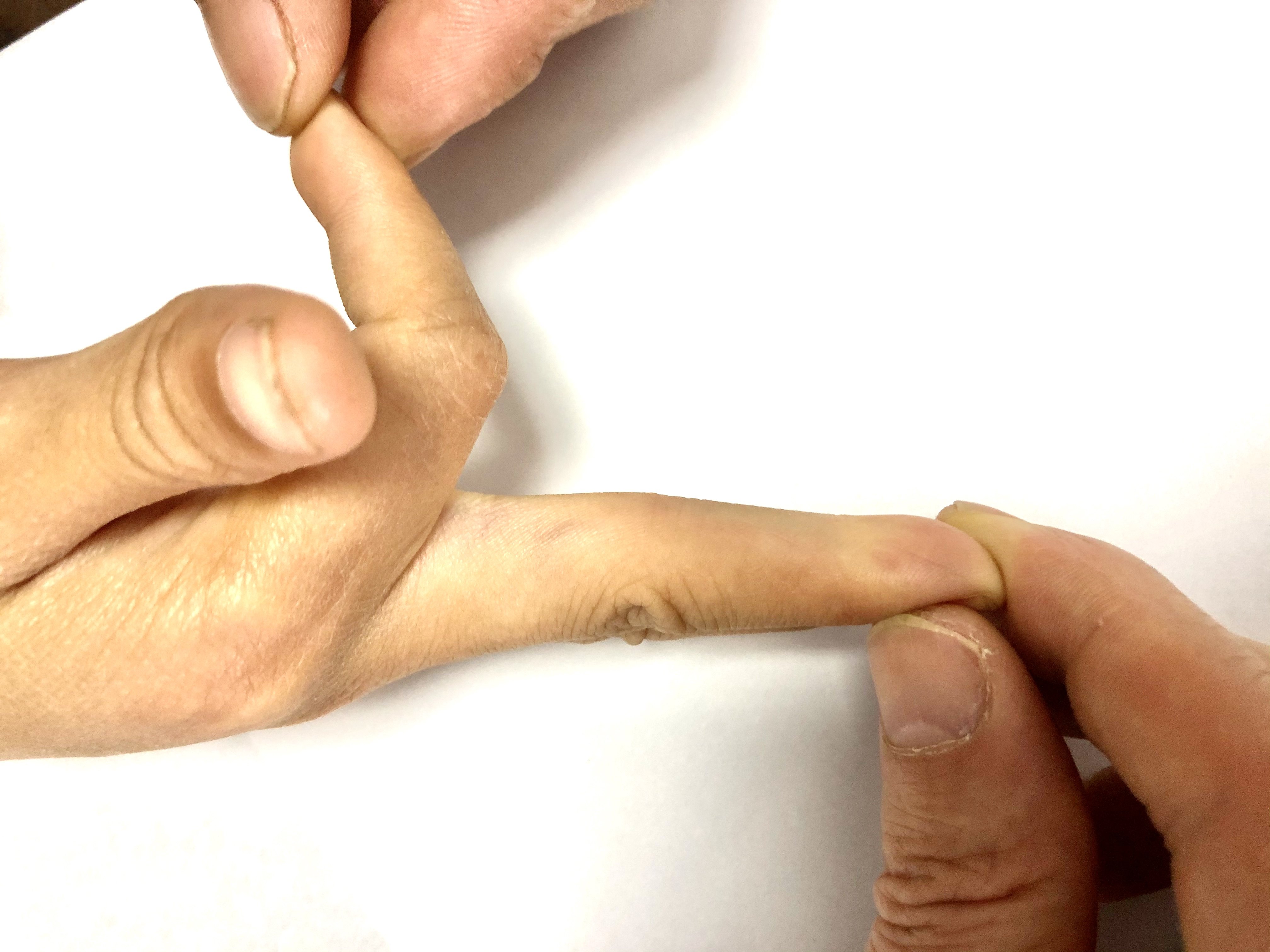 先天性双手3-5指深屈肌挛缩一例报告 - 好大夫在线