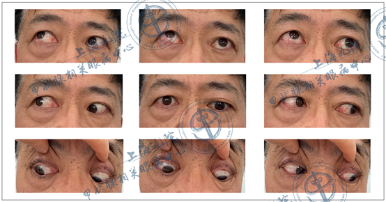 graves眼病系列病例⑦——斜视矫正术_graves眼病_graves眼病治疗方式