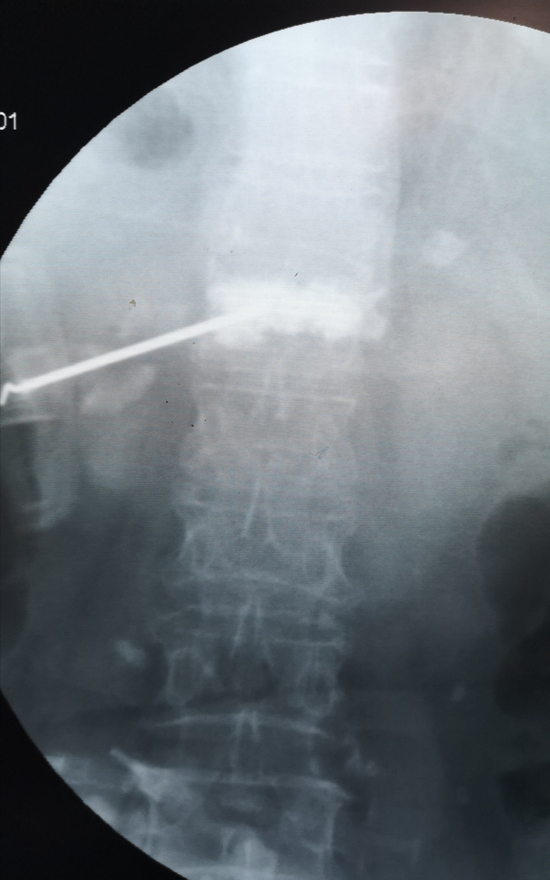 发生了脊柱压缩性骨折,如何治疗?