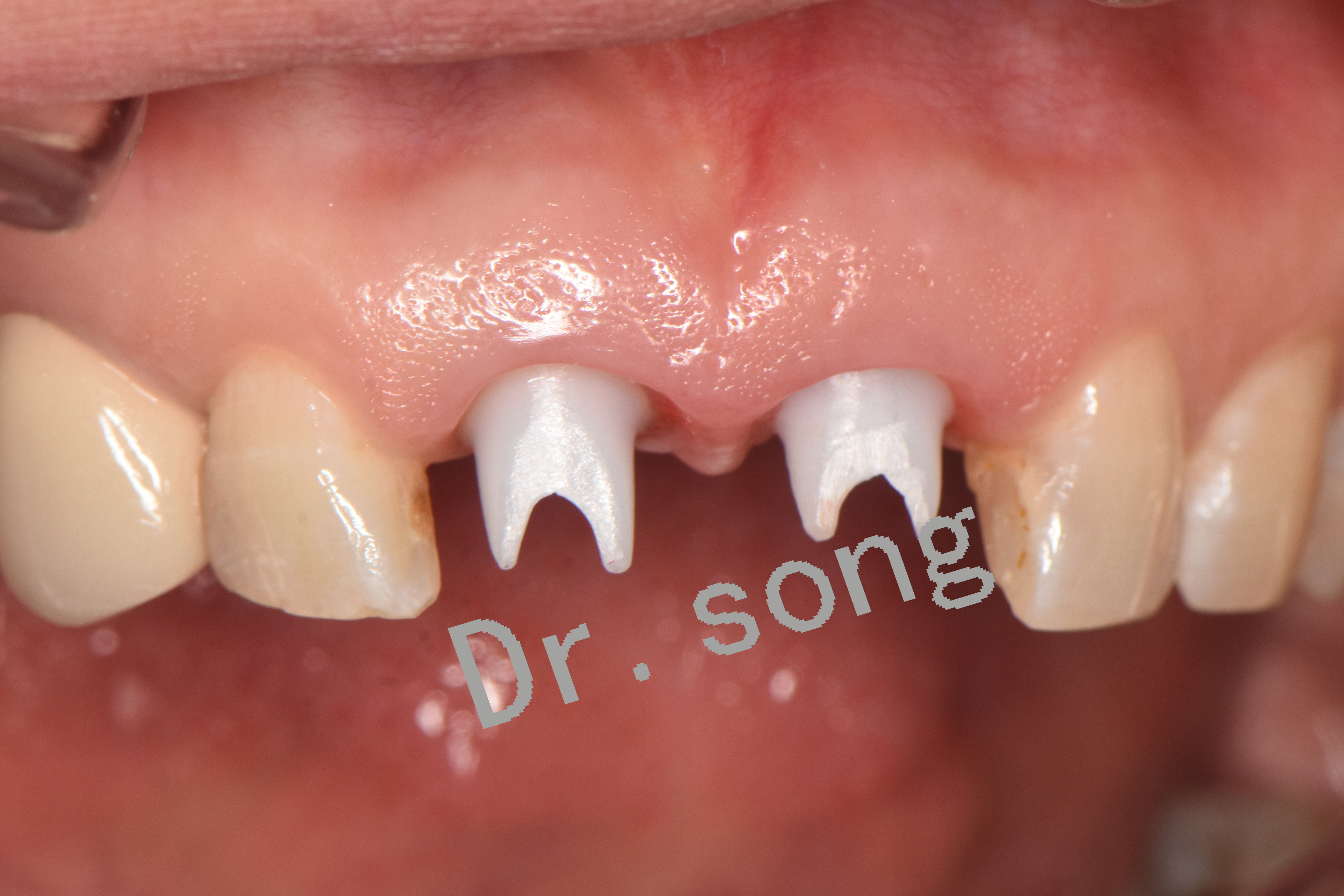 牙苗菜的种植方法及视频_牙种植_一颗种植牙要多少钱