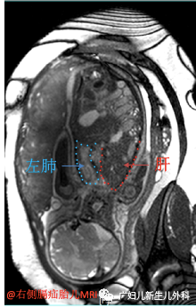 1590461849410219.png 右侧膈疝胎儿MR表现.png