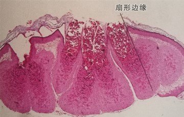 在皮損中央,角質最後破碎而將軟疣小體釋放出來,結果形成火山口