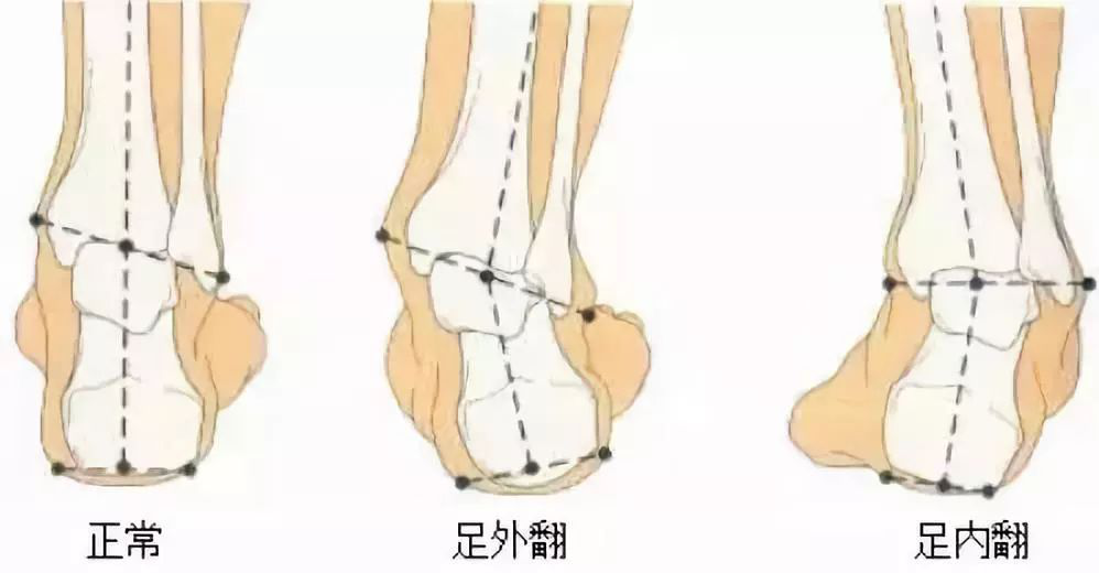 孩子鞋子没选好 小心造成足外翻 足外翻 足外翻 孩子鞋子没选好 小心造成足外翻 足外翻 足外翻
