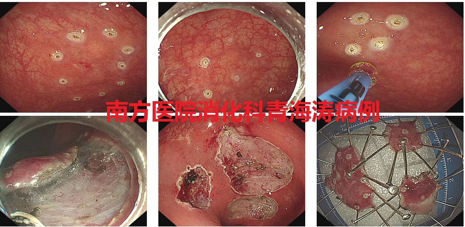 青海濤教授完成直腸多發神經內分泌腫瘤間質瘤多例內鏡切除