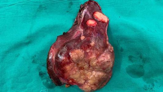 乳腺癌晚期症状图片真人_乳房癌晚期症状图片_乳腺癌晚期症状图片是怎么样的