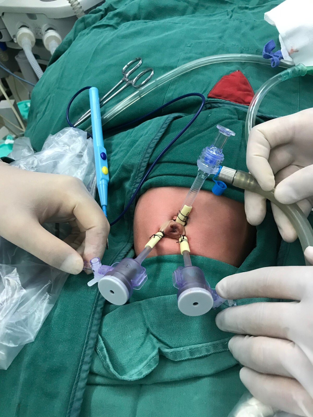 经脐单部位腹腔镜手术治疗新生儿十二指肠梗阻(肠旋转不良,十二指肠