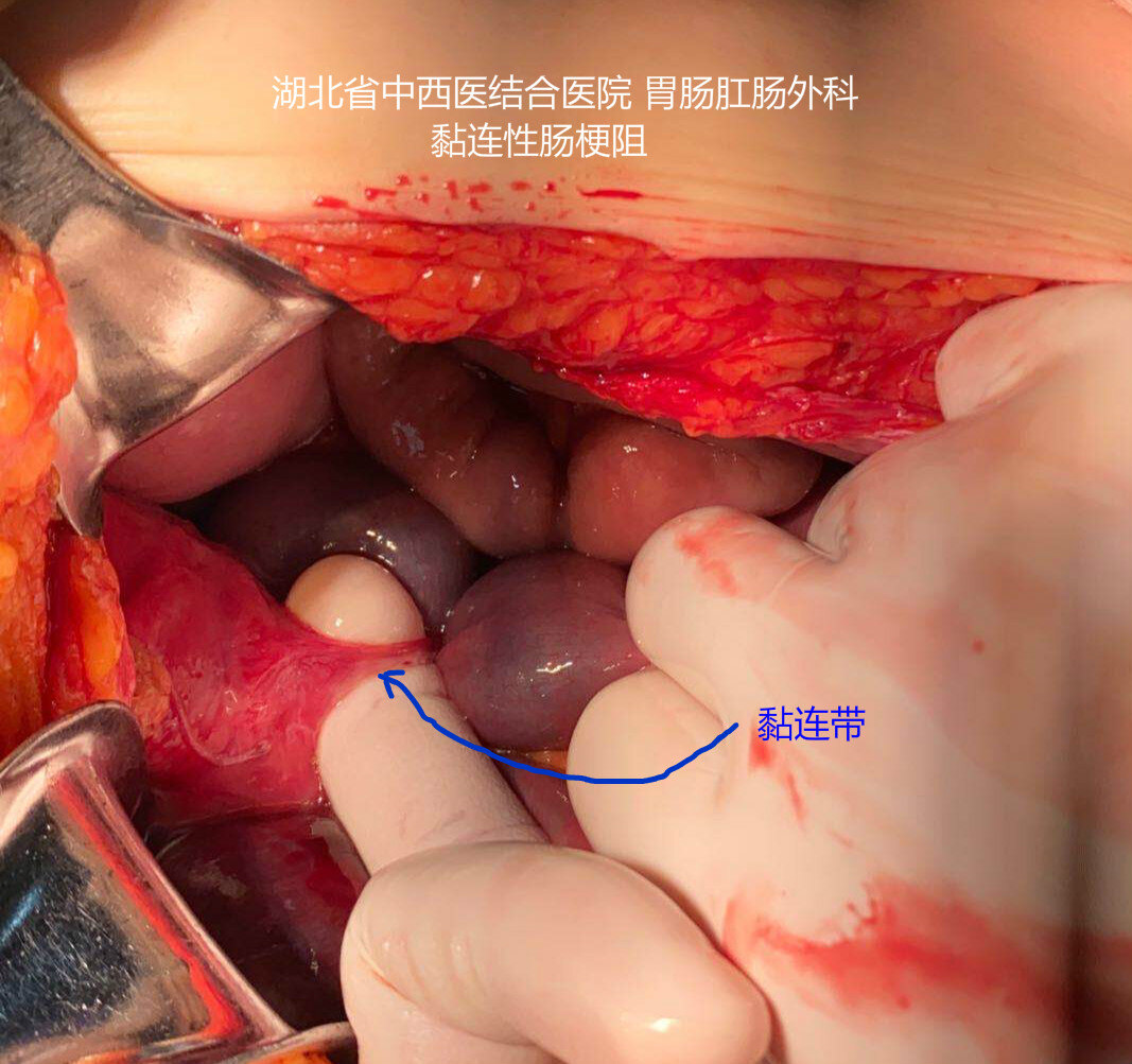 肠梗阻手术疤痕图片图片