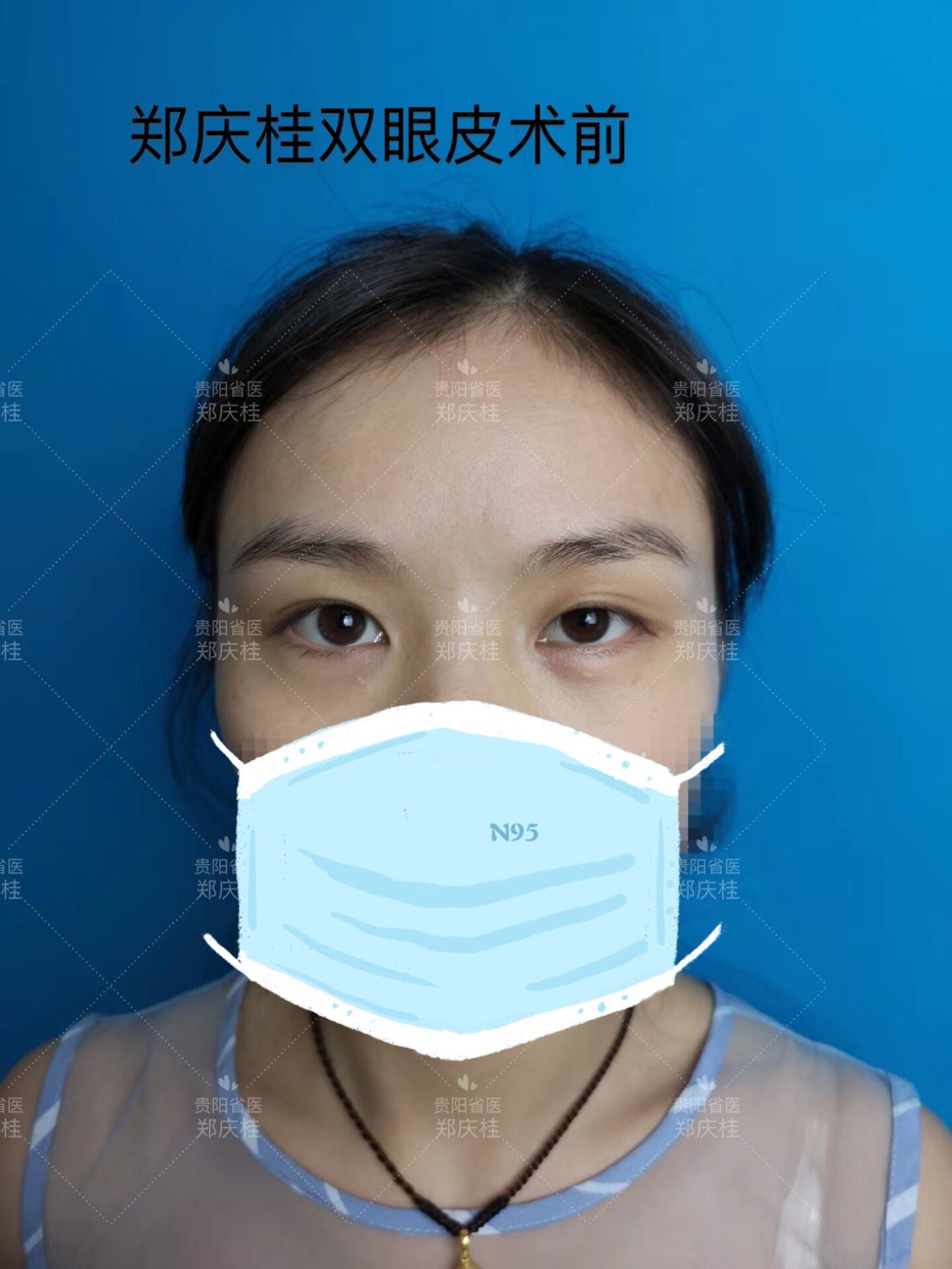 严重大小眼 一单一双双眼皮怎么做 双眼皮手术 双眼皮手术