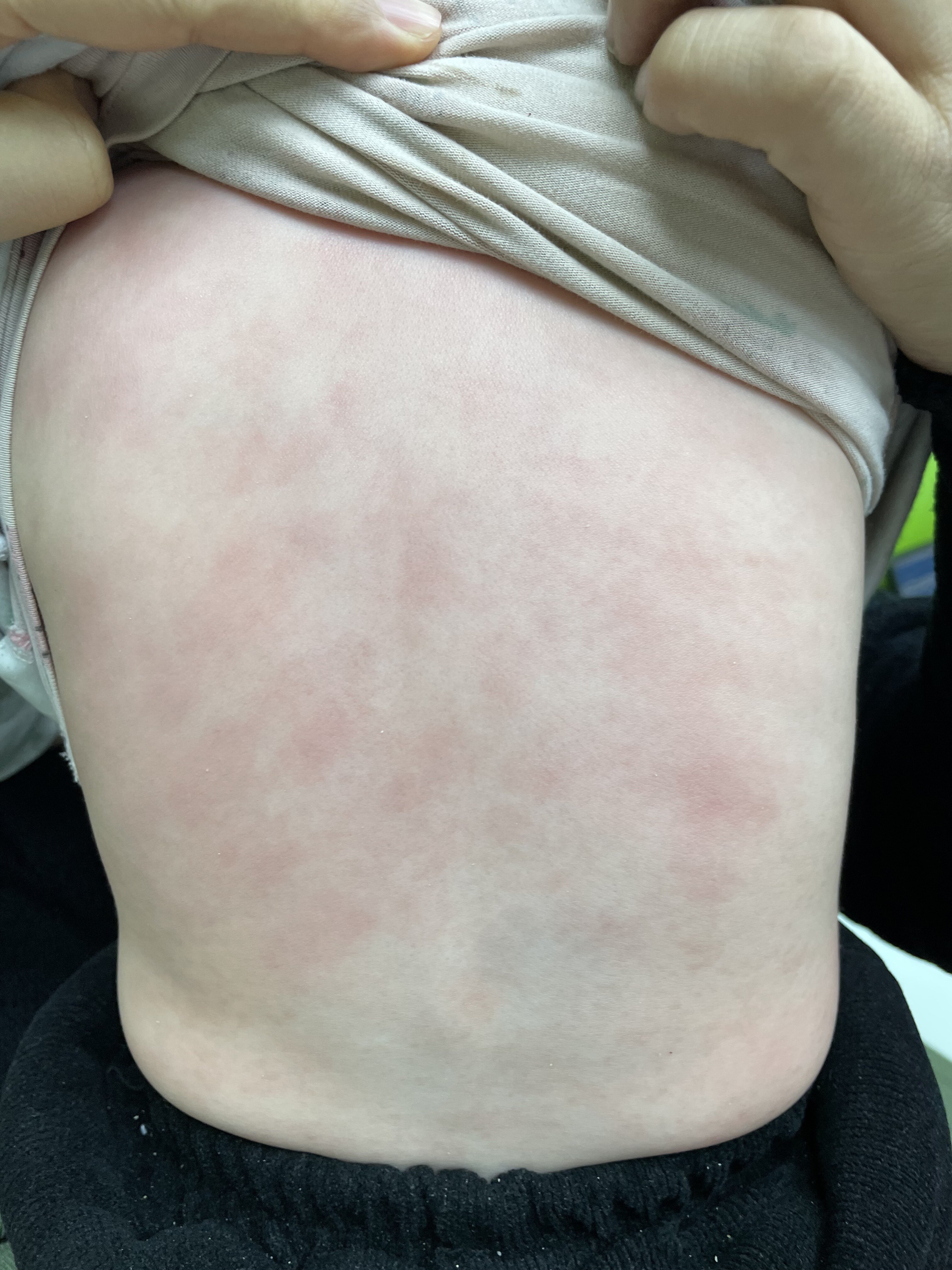 治疗可以使用生物制剂,疗效好,安全性高