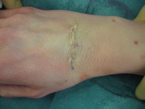 手腕部关节镜微创手术和开放手术的疤痕对比