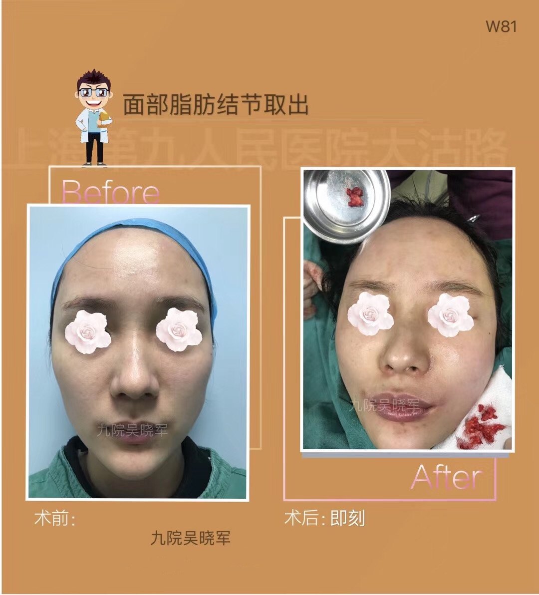 面部脂肪结节取出_脂肪填充_脂肪填充 - 好大夫在线