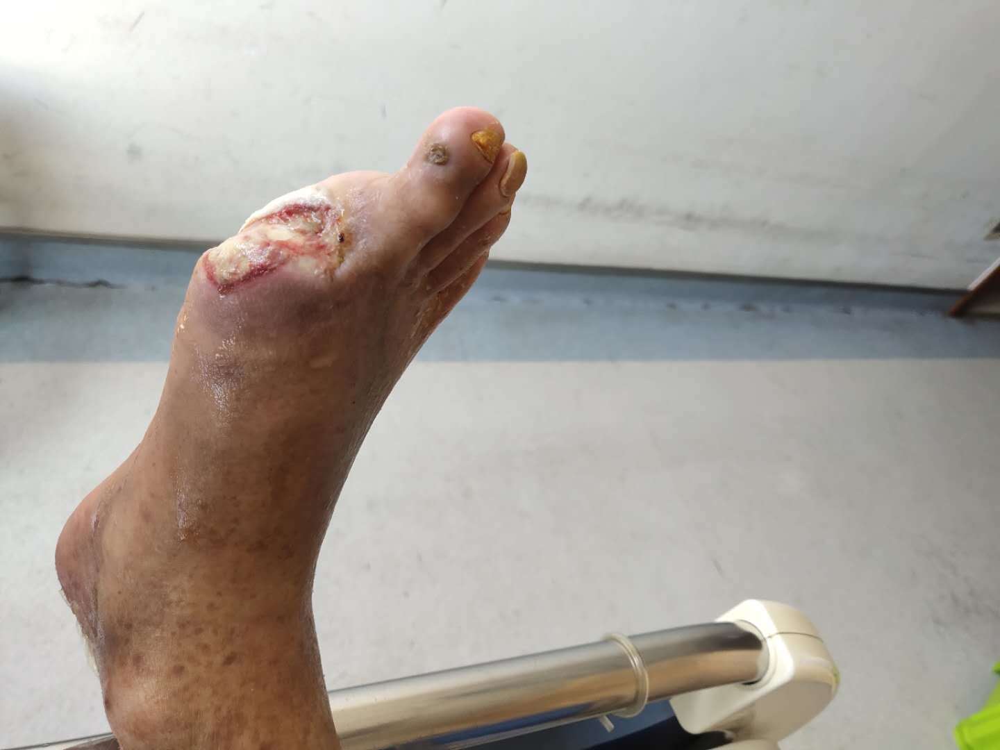 出院前换药:用生理盐水及康复新液清洁伤口 普朗特湿敷10分钟 生长