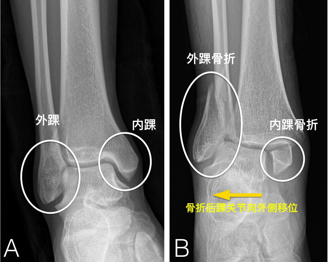 踝关节骨折及术后康复策略 踝部骨折 踝部骨折 踝关节骨折及术后康复策略 踝部骨折 踝部骨折