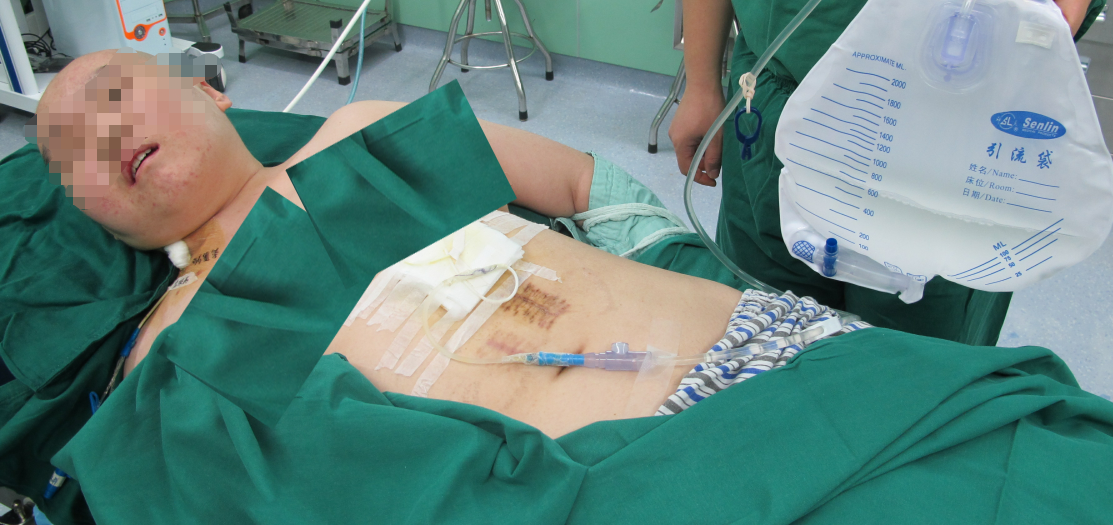 6家医院经1年余4次脑室外引流术和2次脑室腹腔分流术后仍颅内感染脑