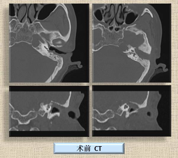 岩尖胆脂瘤是重疾吗 岩尖部脑膜瘤术后能活多久