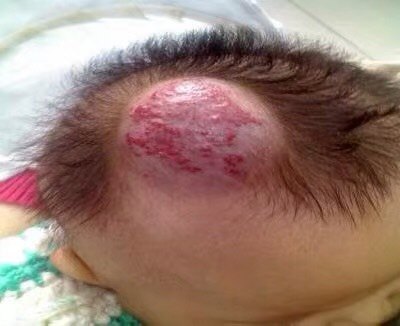 血管瘤治疗理念与实践_皮肤血管瘤_皮肤血管瘤治疗方式 - 好大夫在线